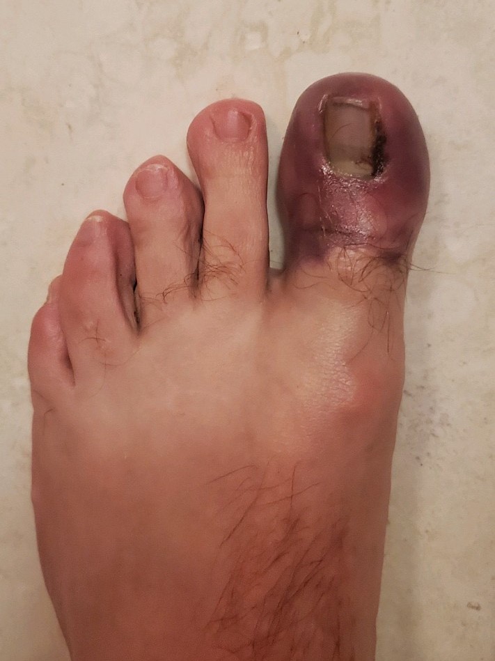 Bad Toe